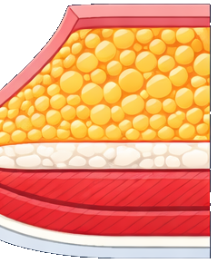 Grade 1 Gynecomastia