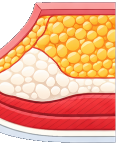 Grade 2 Gynecomastia