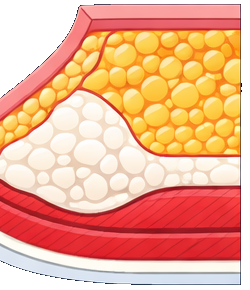 Grade 3 Gynecomastia