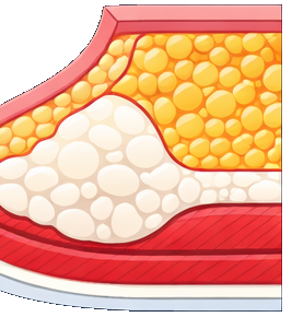 Grade 4 Gynecomastia