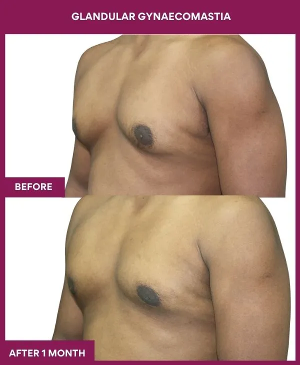Glandular Gynecomastia Before After