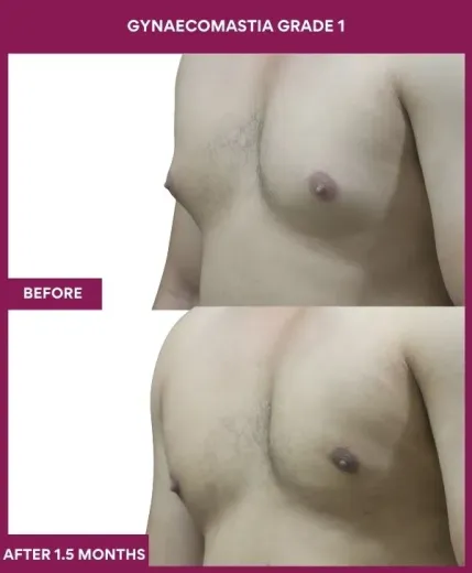 Grade 1 Gynecomastia Front View