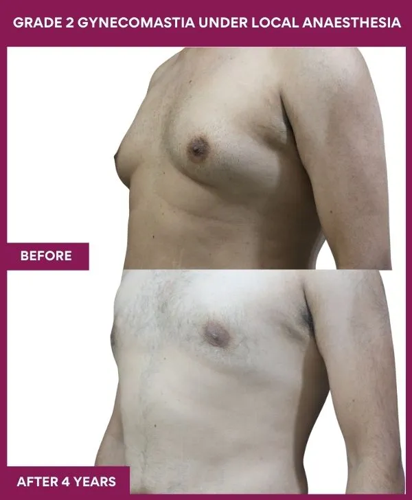 Grade 2 Gynecomastia Front View