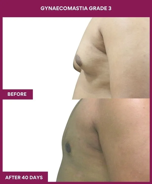 Grade 3 Gynecomastia Front View