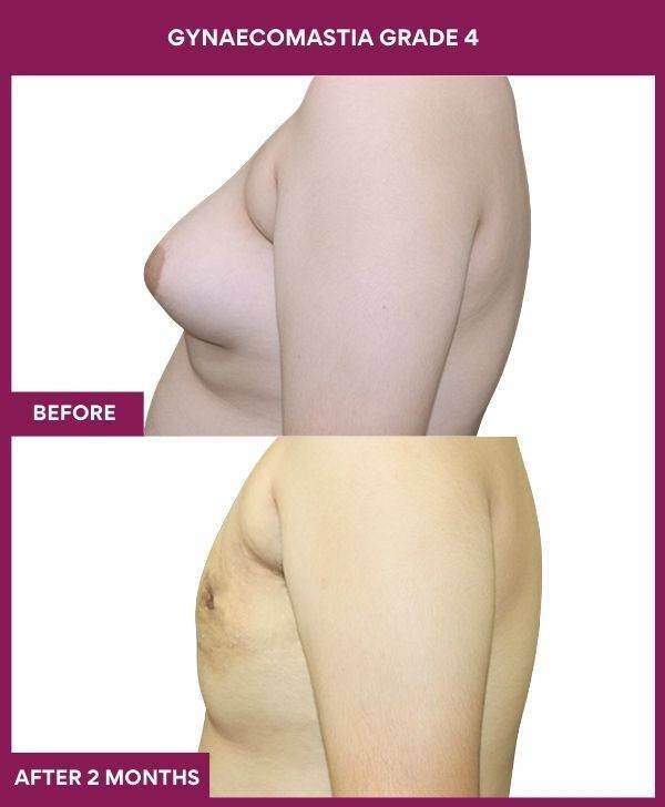 Grade 4 Gynecomastia Before After