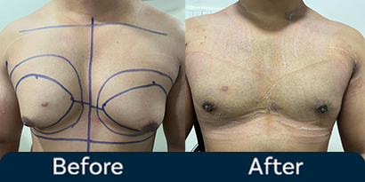 Gynecomastia Grade 1 Before After