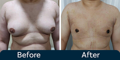 Gynecomastia Grade 2 Before After