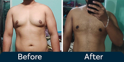 Gynecomastia Grade 3 Before After
