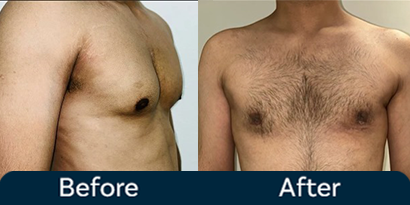 Gynecomastia Grade 2 Before After Side View