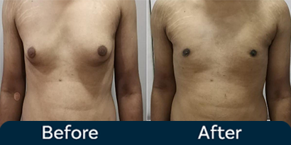 Gynecomastia Severe Before After