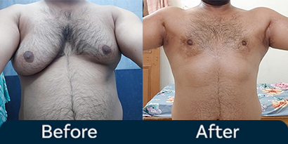 Gynecomastia Surgery Result