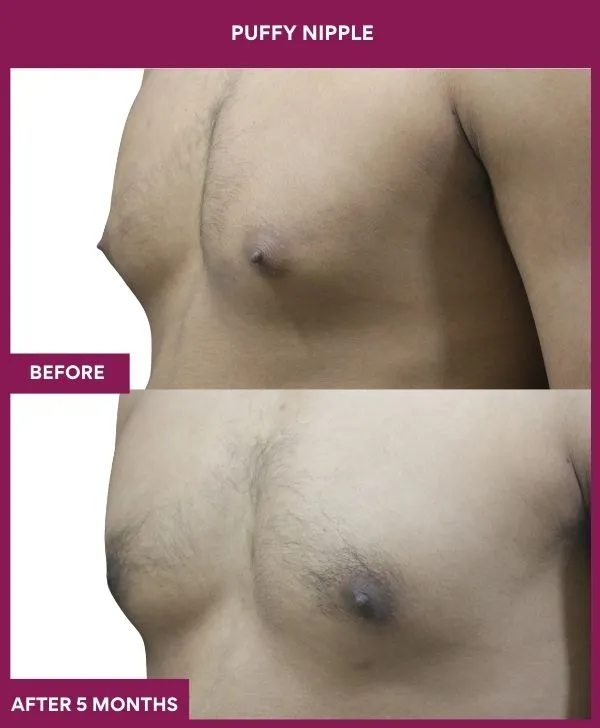Puffy Nipple Before After