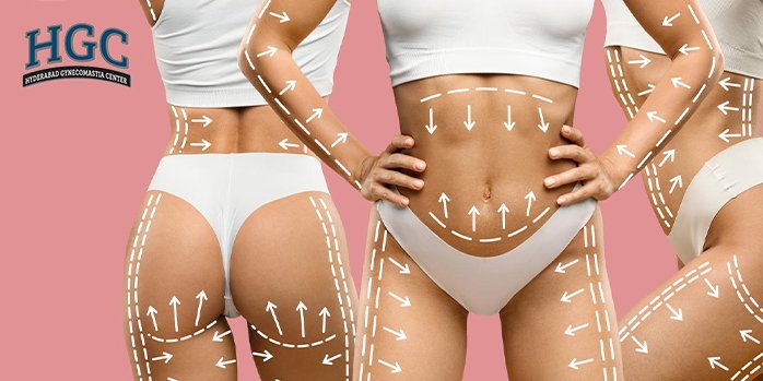 Types of Liposuction and Costs